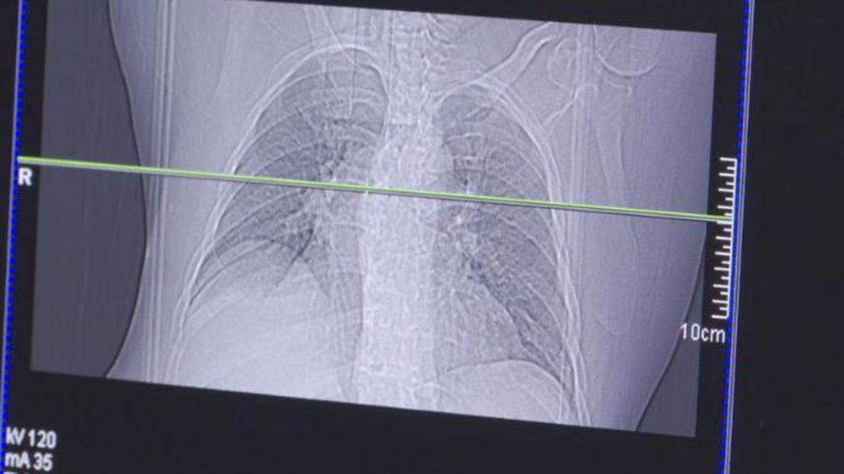 Why is it important to get regular lung cancer screenings?