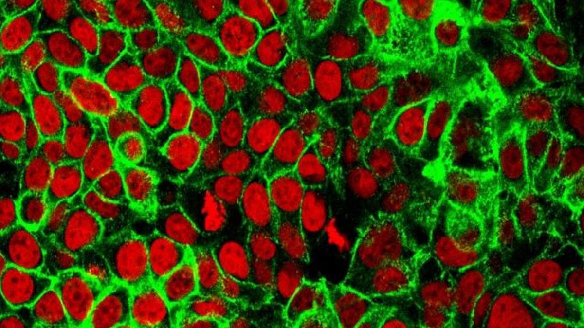 This undated microscope image provided by the National Institutes of Health shows cancer cells with the cell nuclei stained red. The U.S. Food and Drug Administration approved the use of Paige Prostate, the first AI-based software that can identify cancerous slide images with better accuracy. (NIH via AP)
