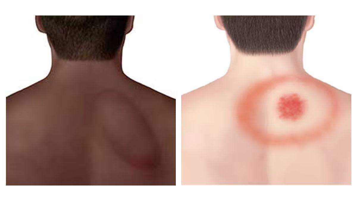 ODH says some of the common symptoms of tick-related illnesses are fevers, rashes and aches and pains.