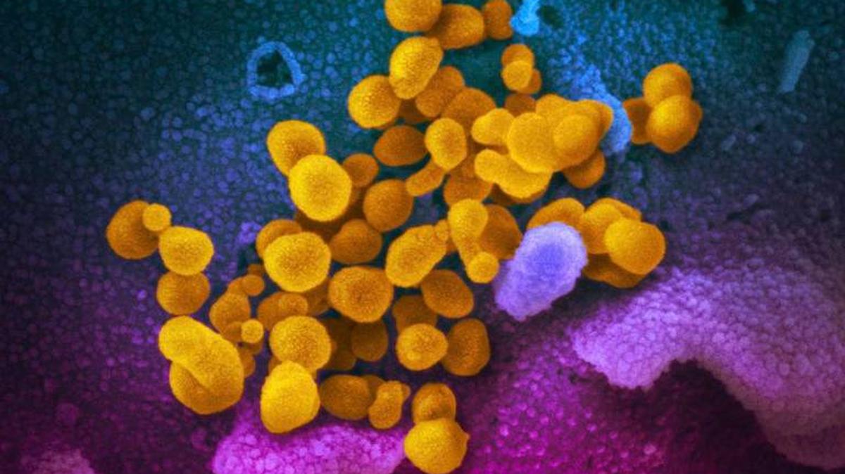 This undated electron microscope image made available by the U.S. National Institutes of Health in February 2020 shows the Novel Coronavirus SARS-CoV-2, yellow, emerging from the surface of cells, blue/pink, cultured in the lab. AP FILE