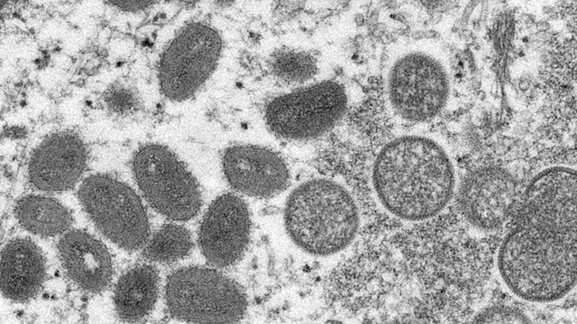 The first locally transmitted monkeypox case was reported this week in Dallas County.