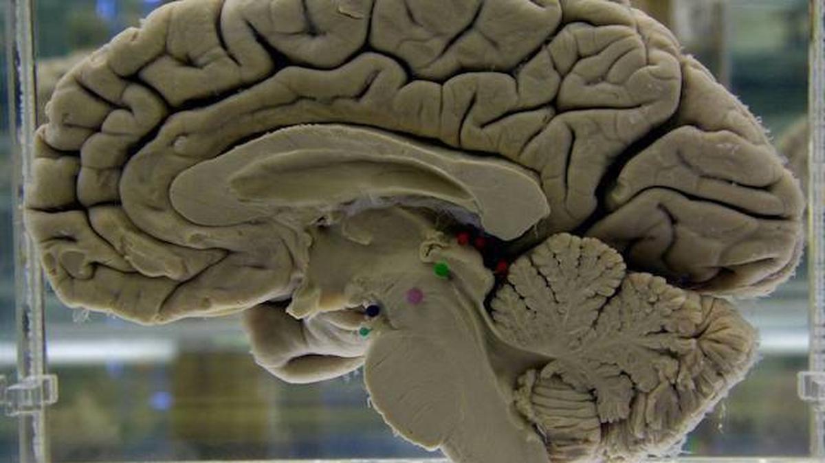 This 2003 photo shows a section of a preserved human brain on display at the Museum of Neuroanatomy at the University at Buffalo. A study that followed more than 14,000 adults over 25 years found that just one head injury could raise someone’s chances of developing dementia later in life. 