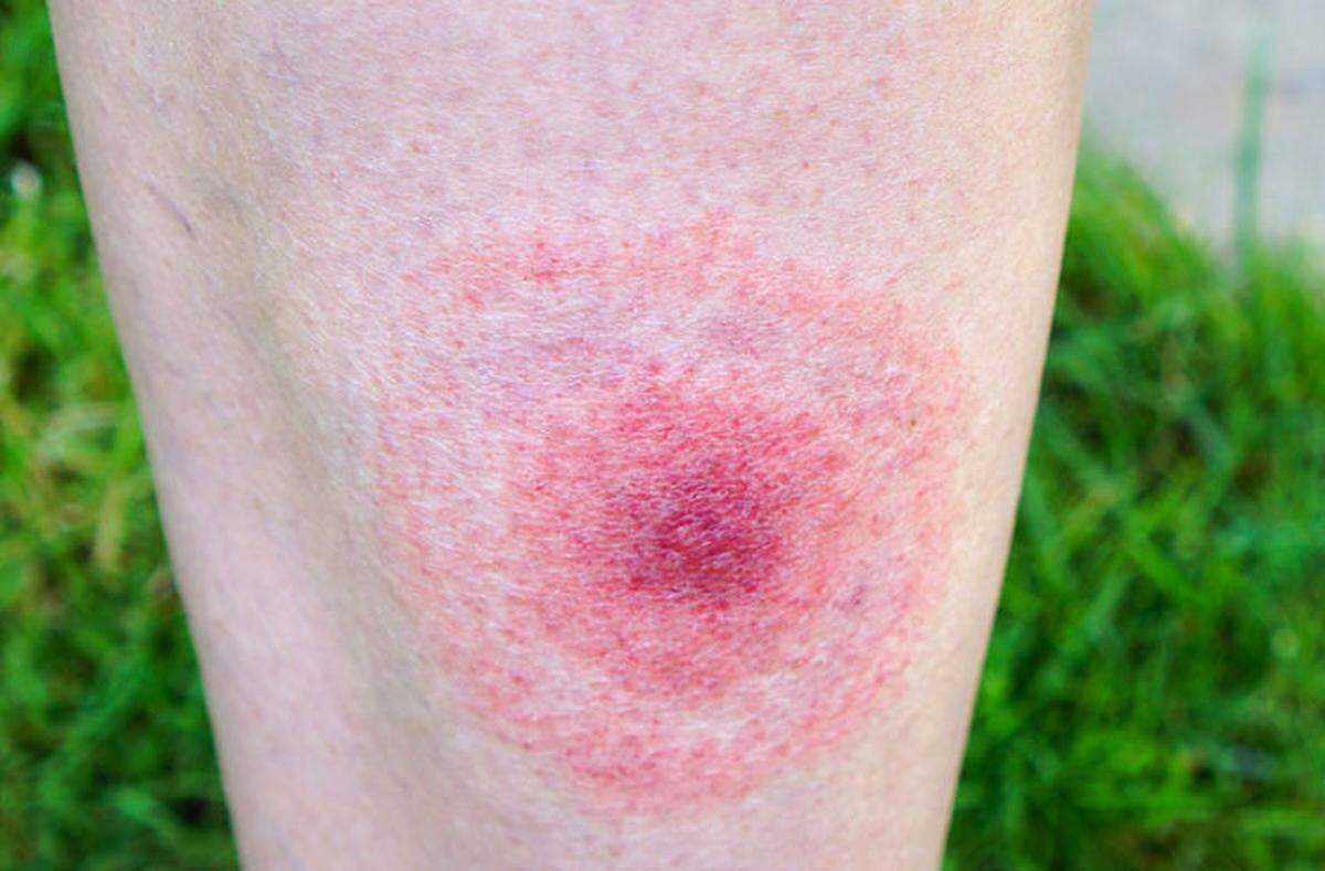 Rashes like the one seen here in this file photo are one of the early symptoms of Lyme disease.