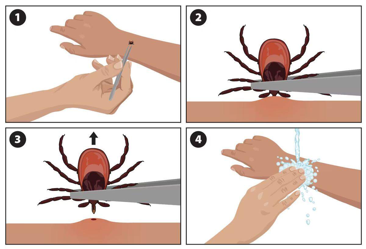 Follow the Centers for Disease Control and Prevention’s guide on how to remove a tick safely.